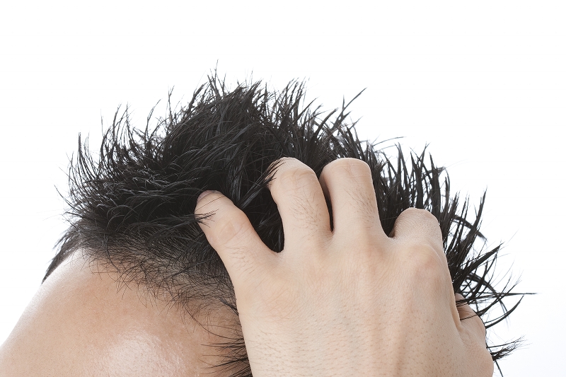 男性の薄毛、AGAの症状とは？